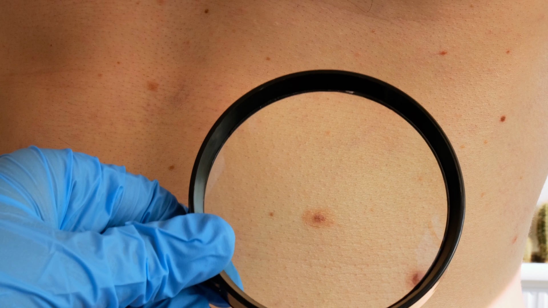 Study: Overdiagnosis Of Skin Cancer Up Over Time