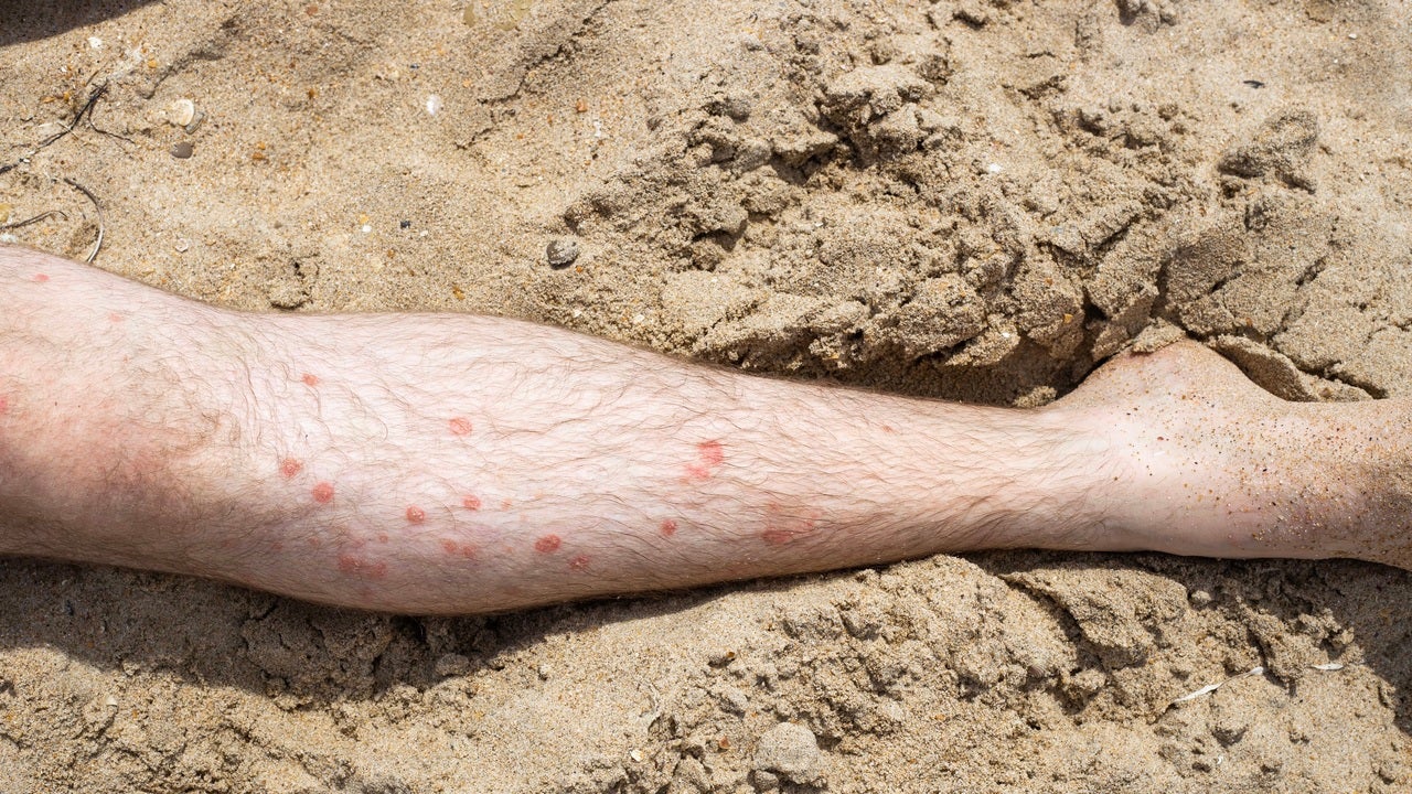 leg with psoriasis on sandy beach