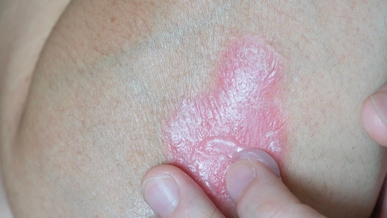 close up of psoriasis