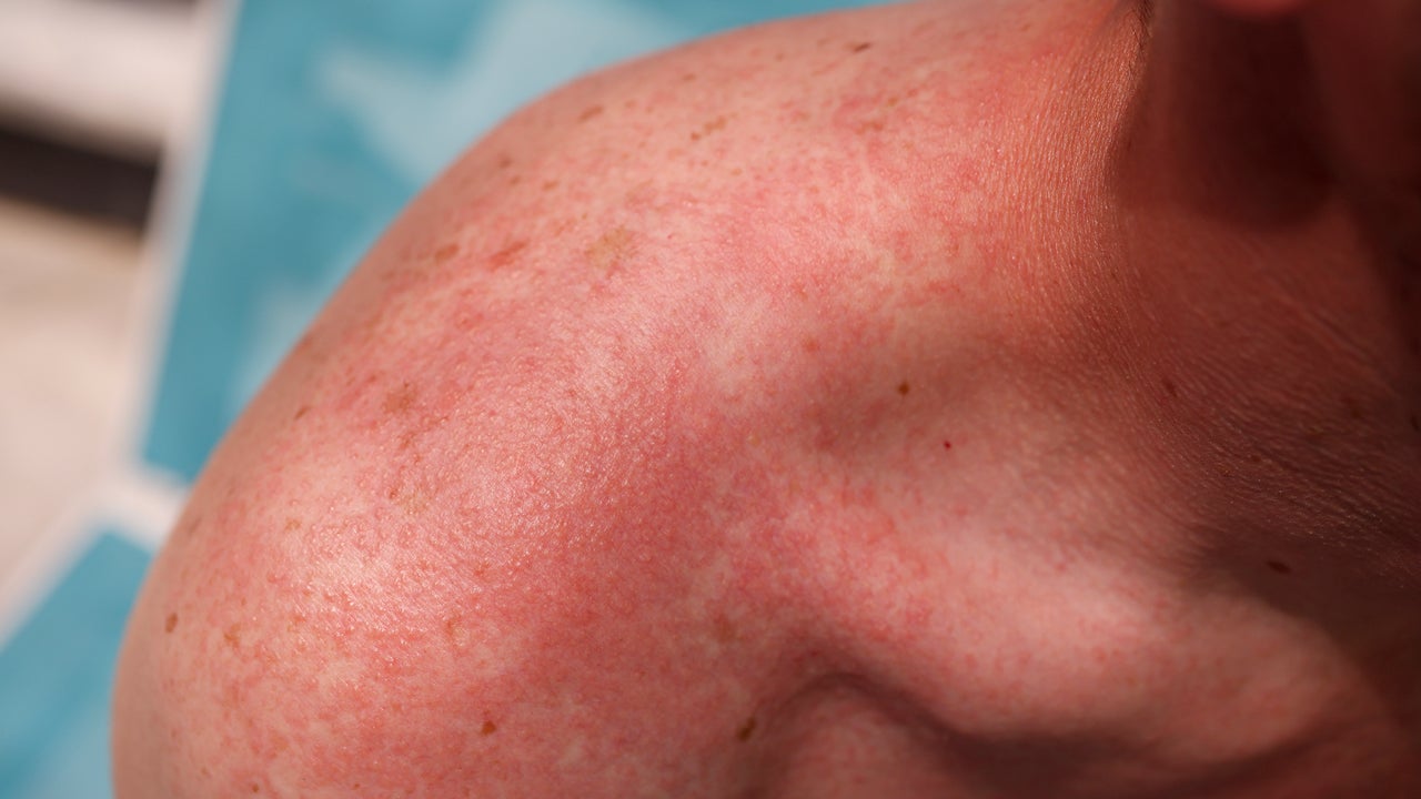 What Is Prickly Heat (Miliaria Rubra)?