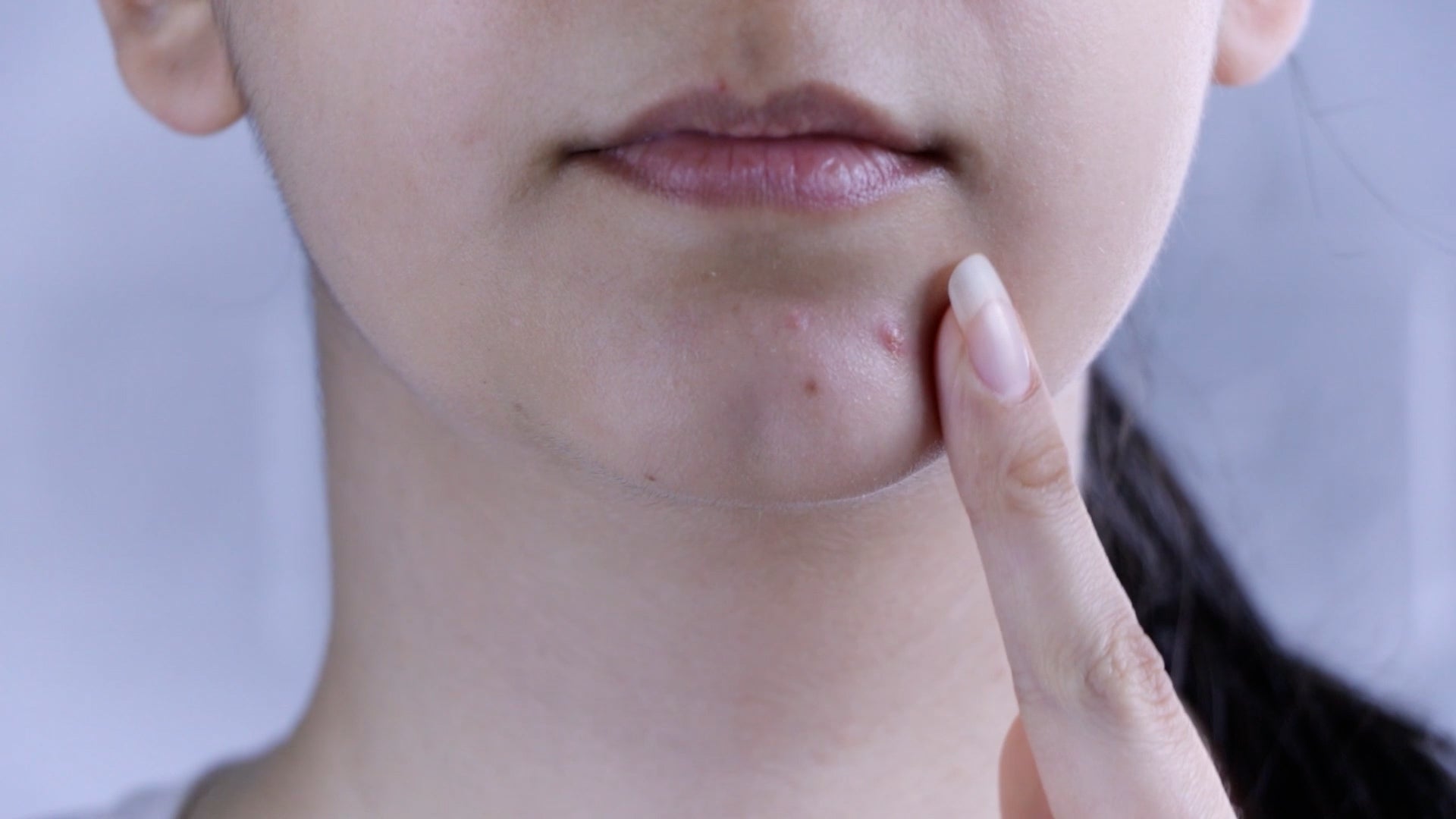 Is It OK To Pop Pimples? 