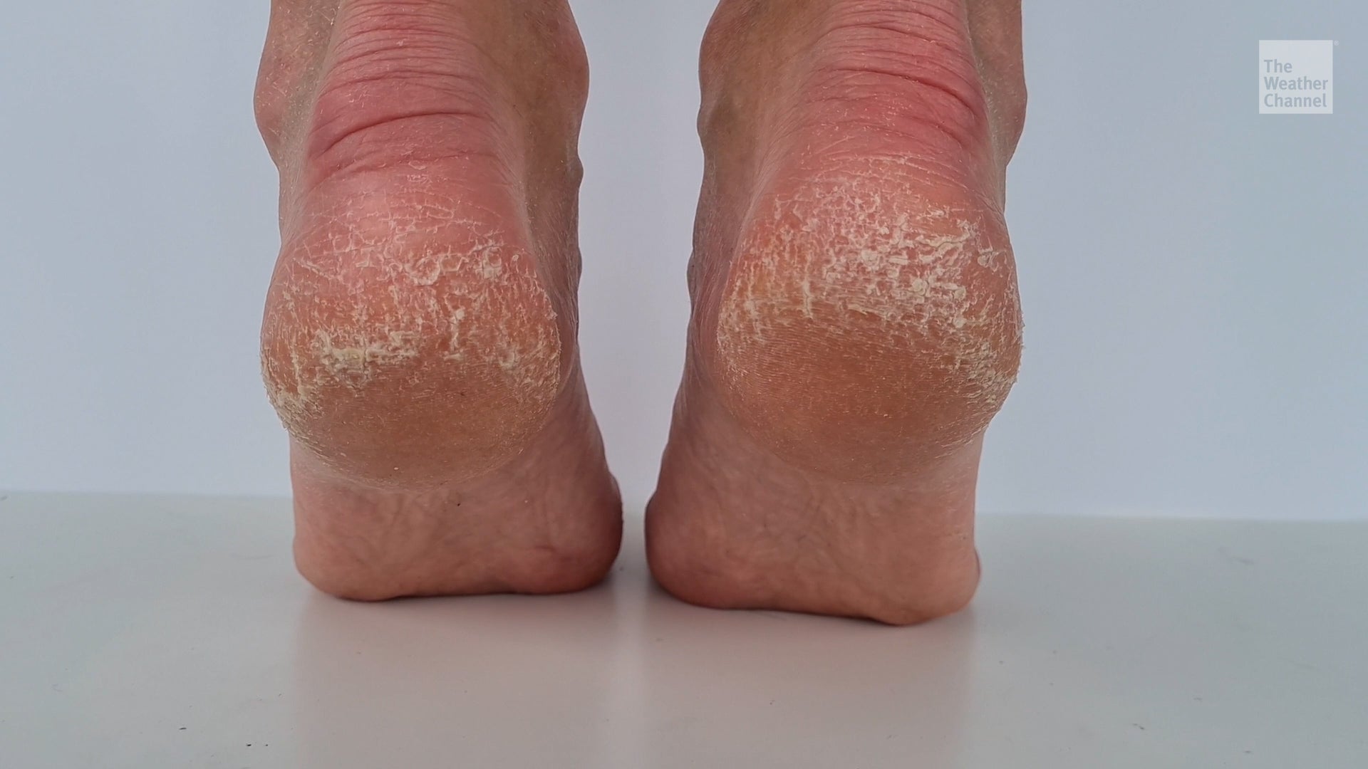 Save Your Soles With Foot Care Secrets For Winter