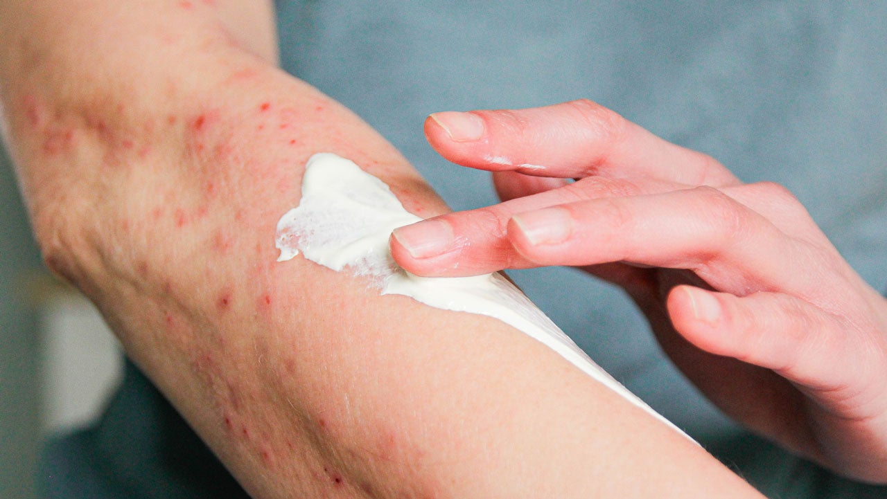 hand rubbing cream on arm with eczema