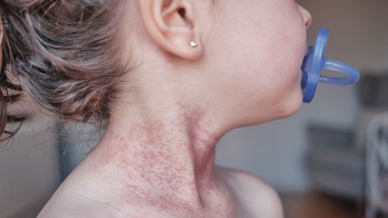 young child with pacifier in mouth and atopic dermatitis on neck and chest