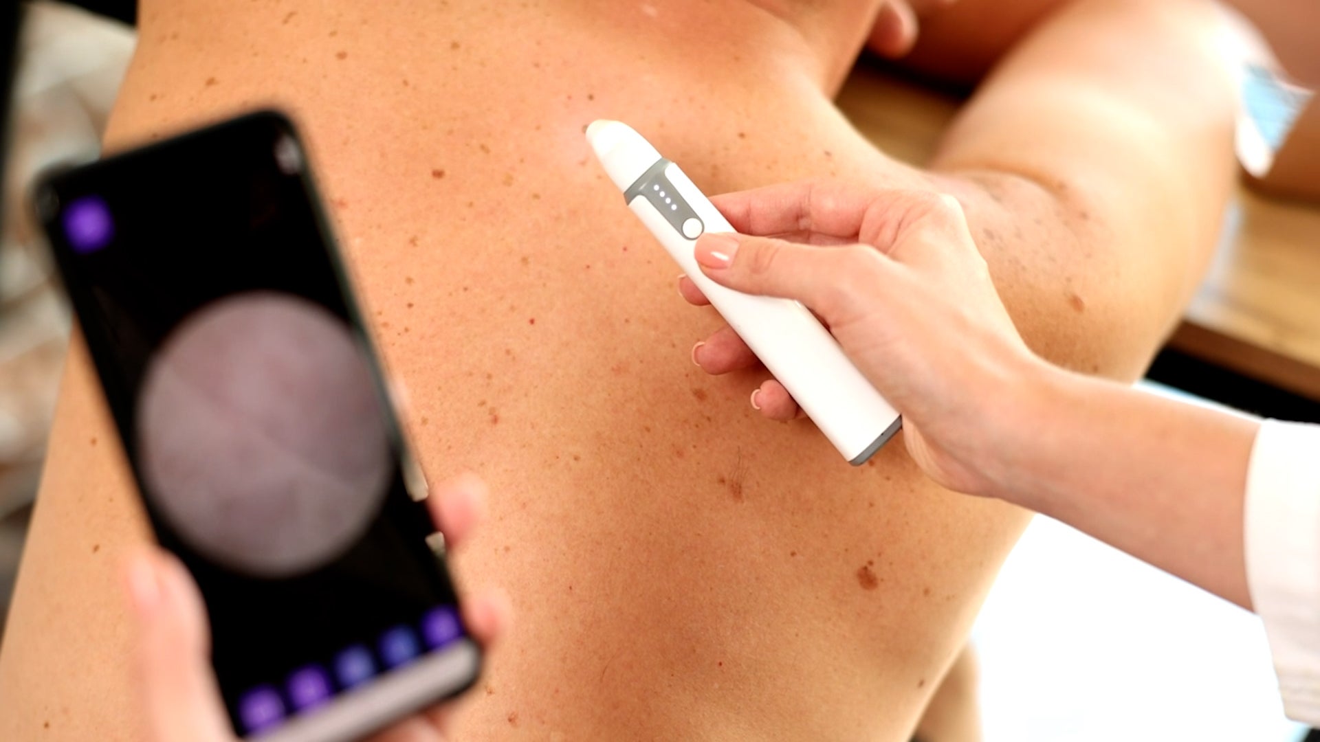 Get Ready For Summer Sun With The ABCs Of Melanoma