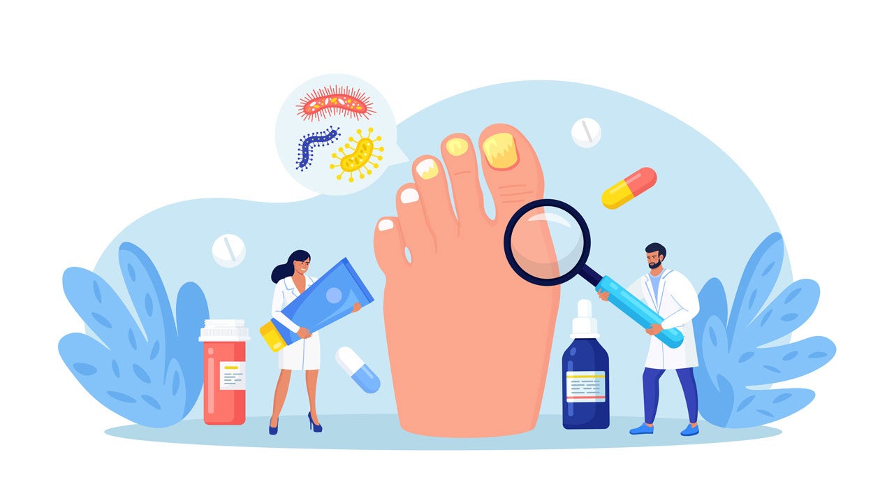 infographic about nail psoriasis with doctors treating an infected foot