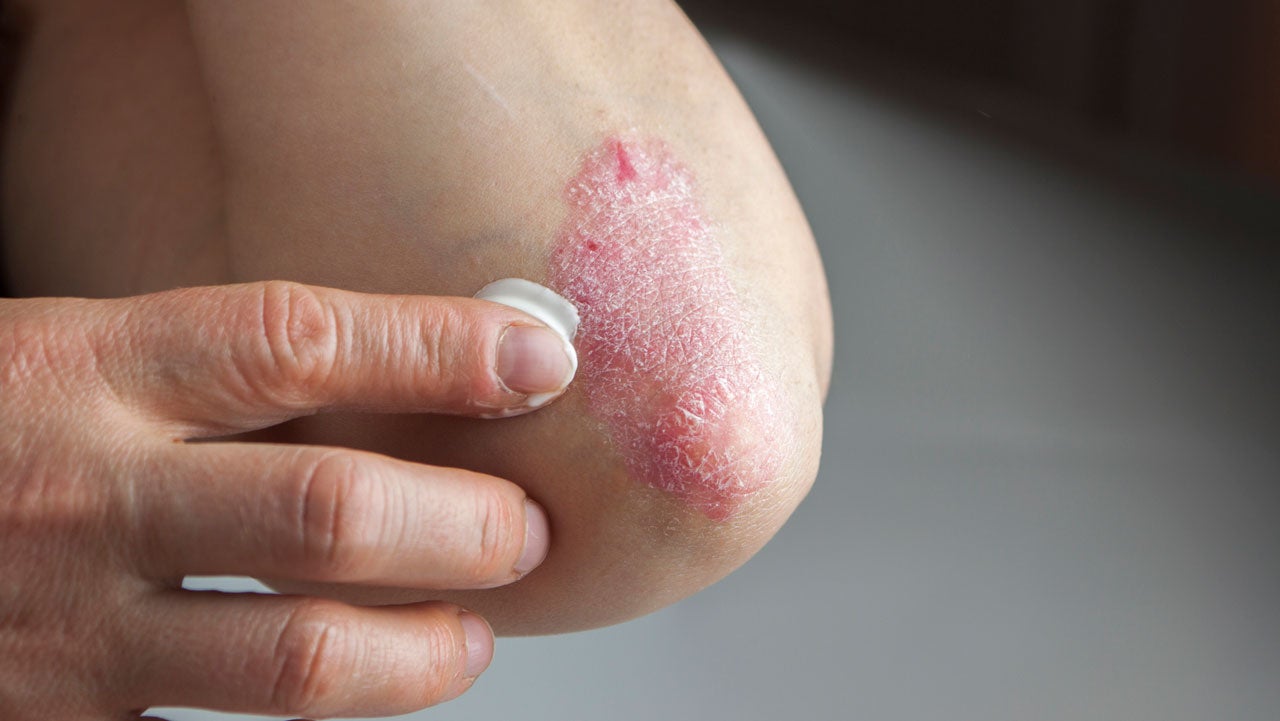 Person applies cream to elbow with plaque psoriasis