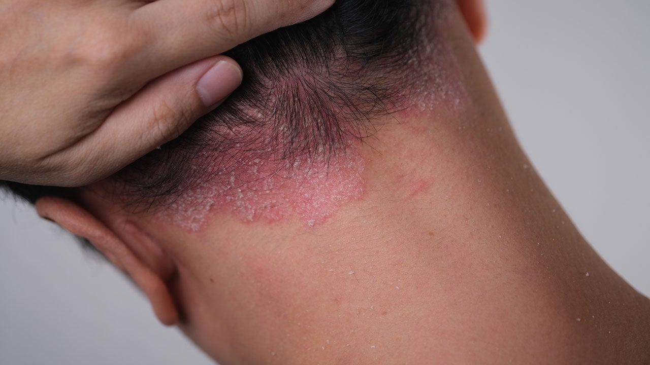 Back of man's head; he's holding up his hair to reveal psoriasis