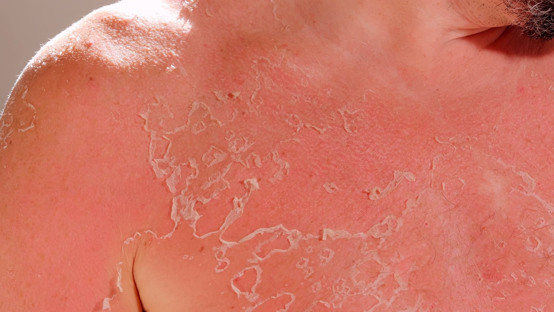 What To Do With Peeling, Sunburned Skin