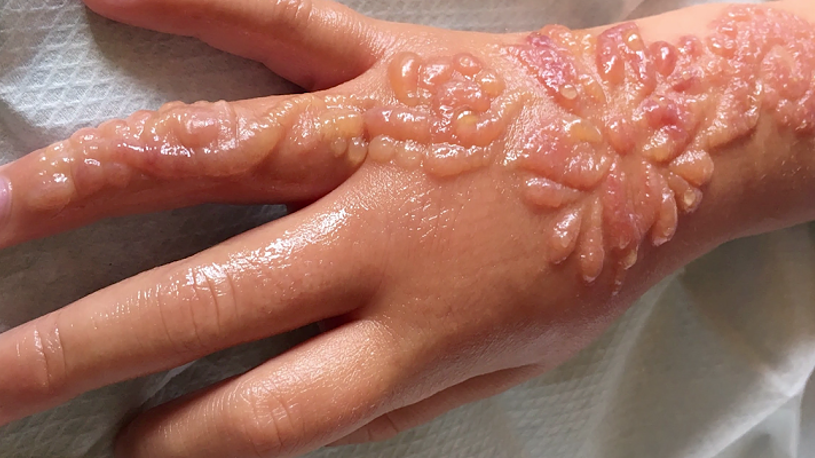 Alptraum Souvenir Siebenjahrige Bekommt Chemische Verbrennungen Durch Henna Tattoo Videos Von The Weather Channel Weather Com Alptraum Souvenir Siebenjahrige Bekommt Chemische Verbrennungen Durch Henna Tattoo Videos Von The Weather Channel Weather Com