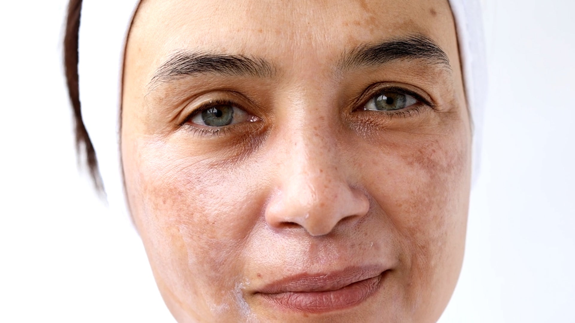 Do You Have Sun Damage Or Melasma? – Videos from CBS26