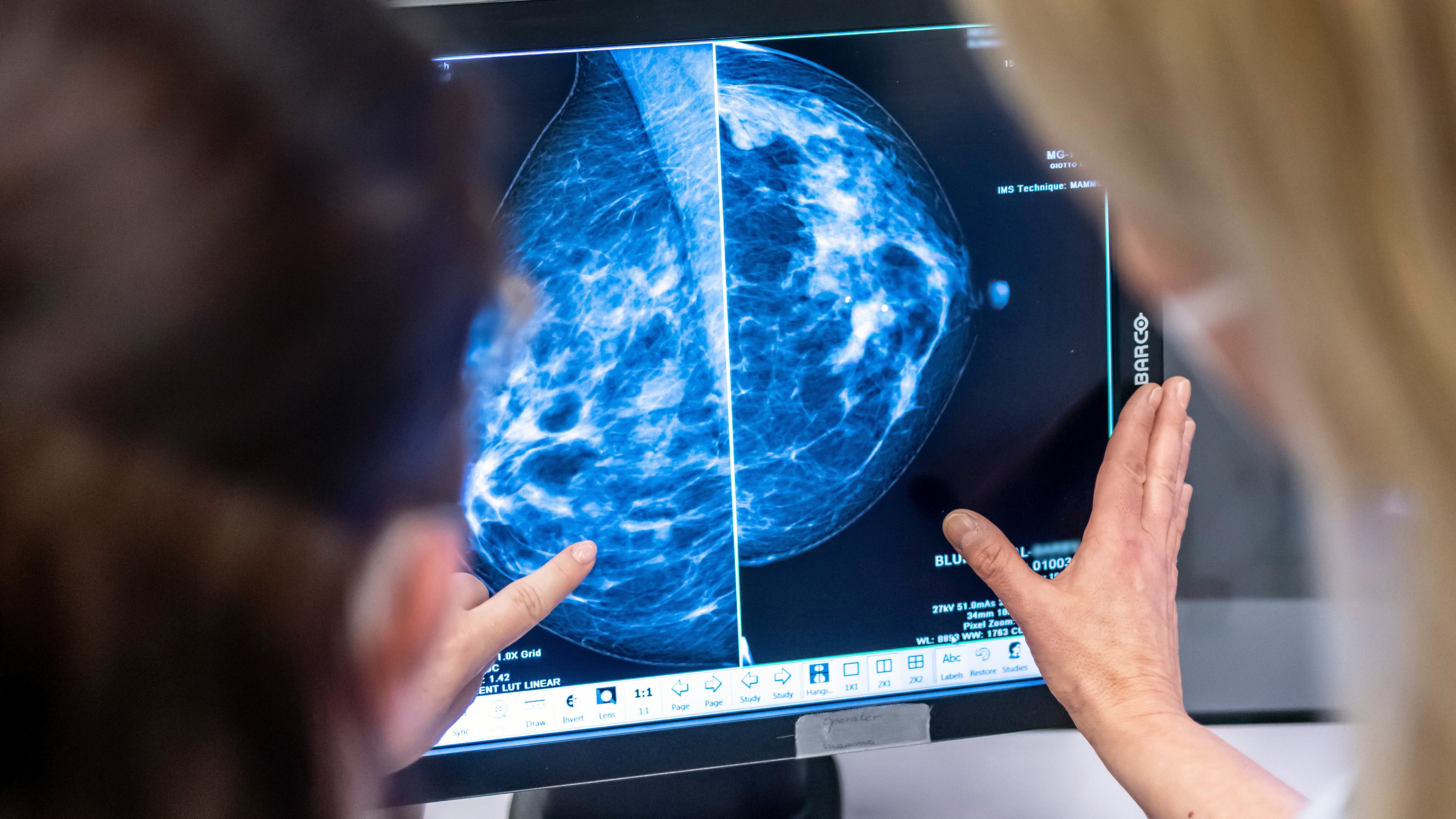 ARCHIV - 25.02.2022, Berlin: Medizinisches Personal untersucht mit einer Mammographie die Brust einer Frau auf Brustkrebs. 