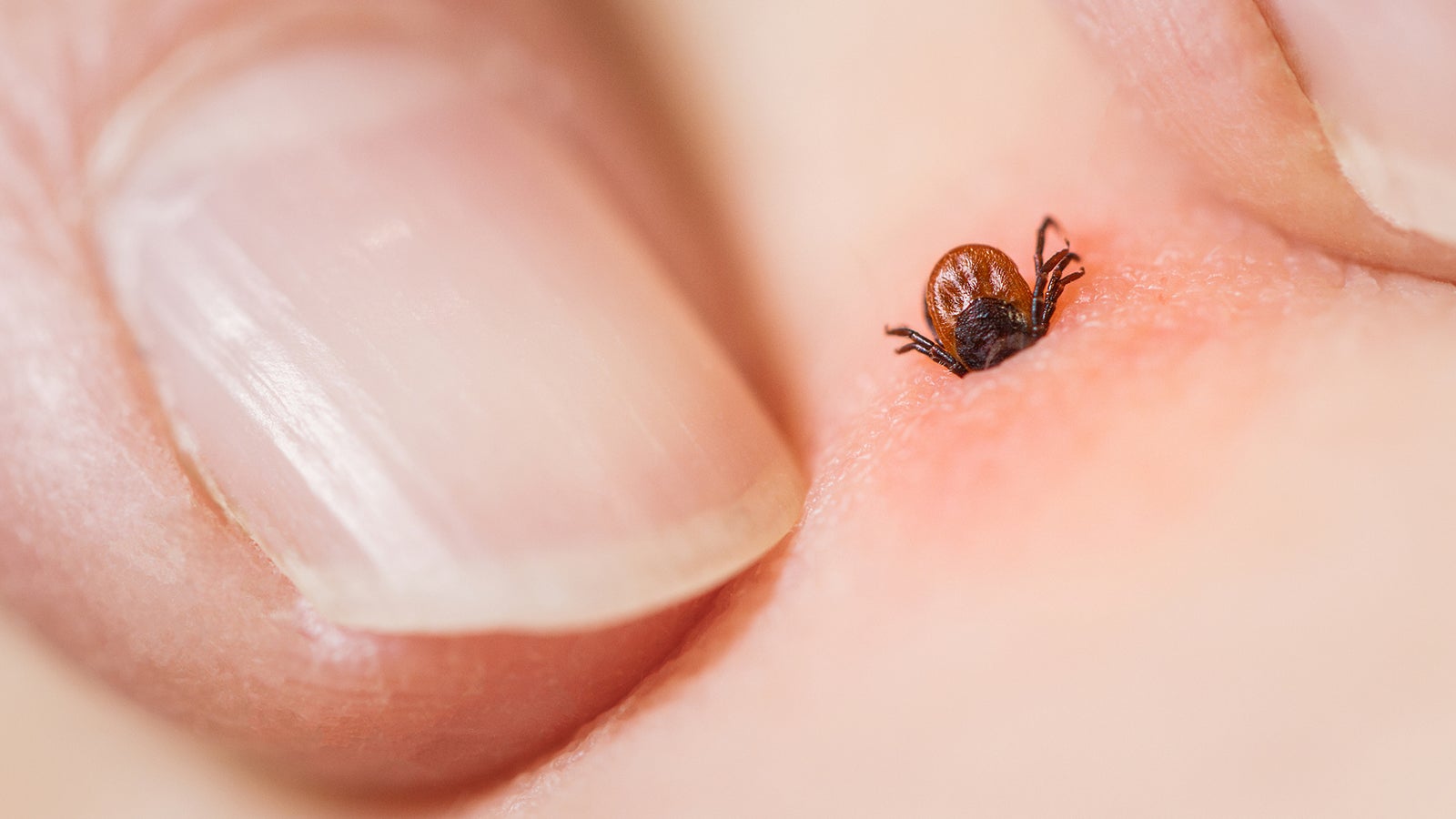 Was tun, wenn man von einer Zecke gestochen wird