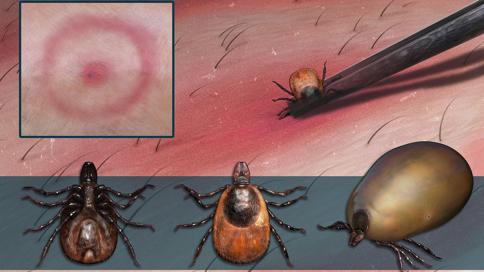 Medical illustration depicting a deer tick s anatomy, along with its bite and removal. Copyright: PhotonxIllustration/StocktrekxImages PHT700066H