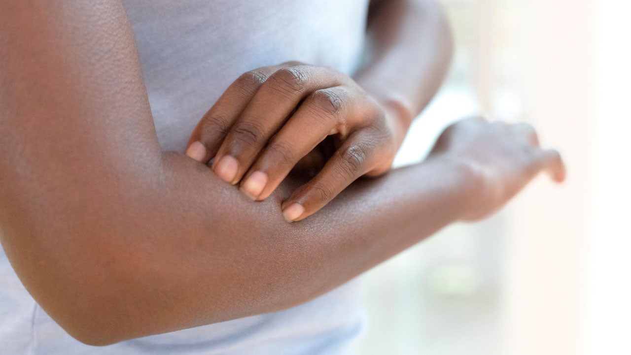 Woman scratching her arm
