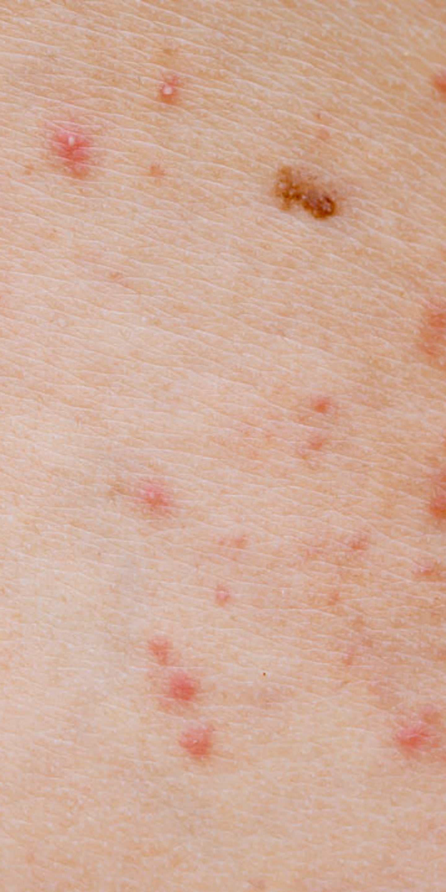 Clear Heat Rash Clear Heat Rash