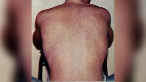Chimerism Rash Human Chimera Symptoms
