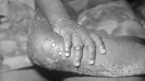 Monkeypox lesions (CDC)