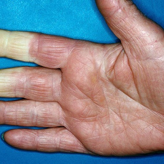 Werden Ihre Finger Bei Kalte Plotzlich Blass Und Taub Dahinter Konnte Eine Krankheit Stecken The Weather Channel Artikel Von The Weather Channel Weather Com Werden Ihre Finger Bei Kalte Plotzlich Blass Und Taub Dahinter Konnte Eine Krankheit Stecken The Weather Channel Artikel Von The Weather Channel Weather Com