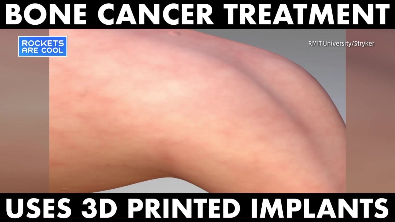 3D Printed Parts Aid Bone Cancer Patients