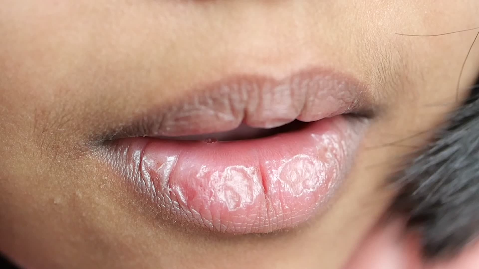 5 Ways To Cure Chapped Lips