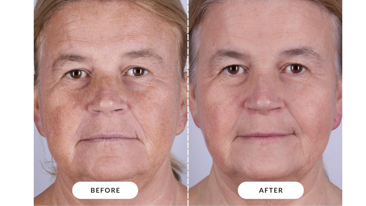 CurrentBody Skin LED Light Therapy Mask: Before and after comparisons