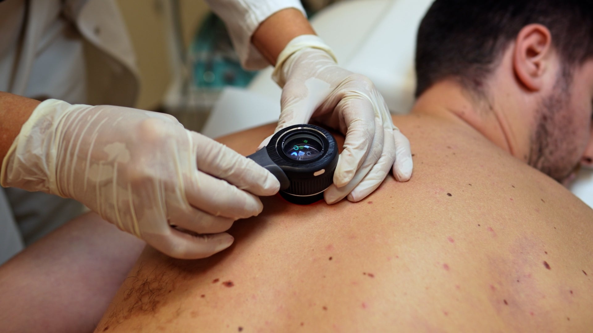 Medical professional wearing latex gloves examining a patient's back with a dermatoscope to inspect moles and skin spots