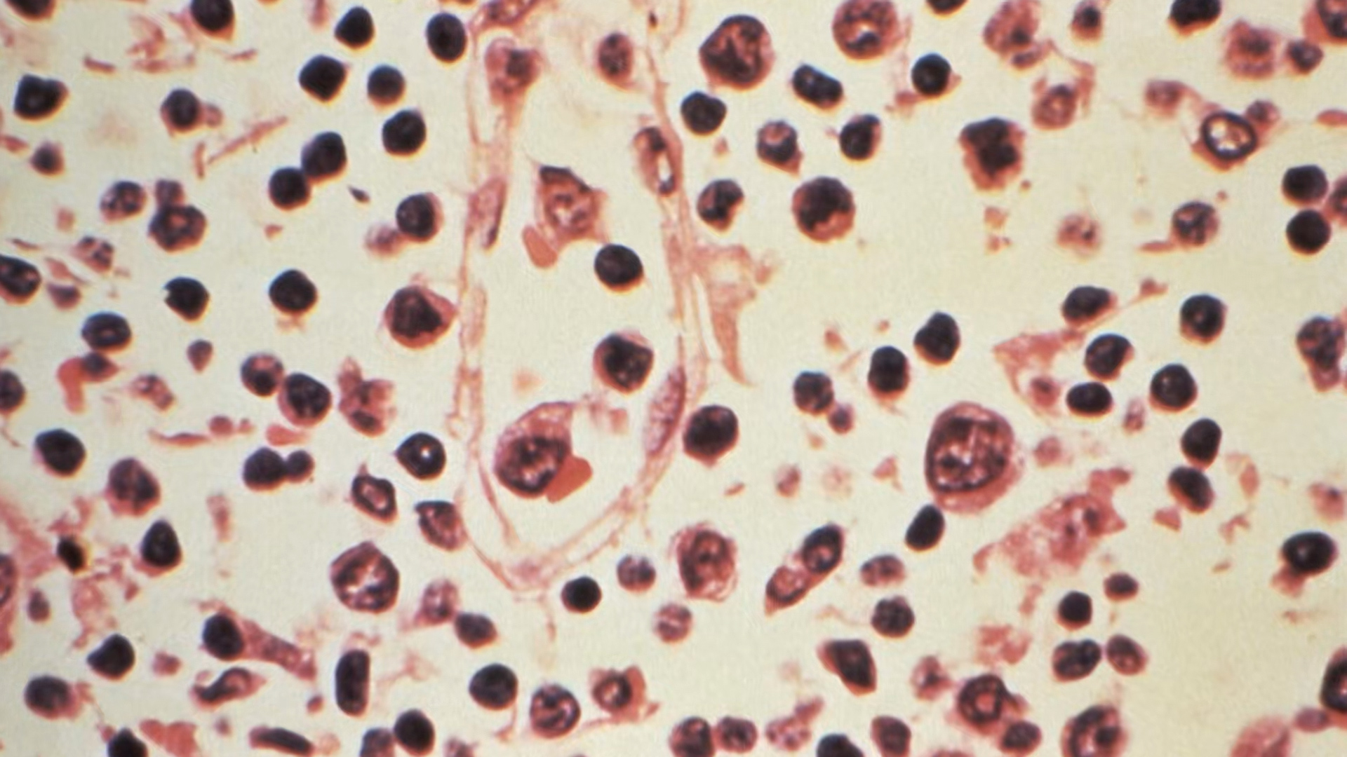 Microscopic view of stained tissue sample showing numerous dark purple and pink circular cells scattered across a light background