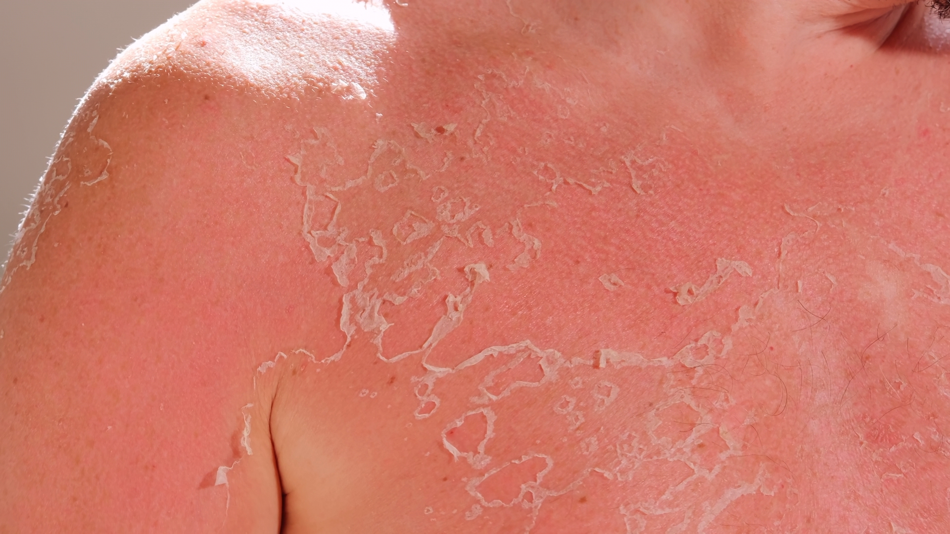 The sunscreen advice on TikTok that could hurt you