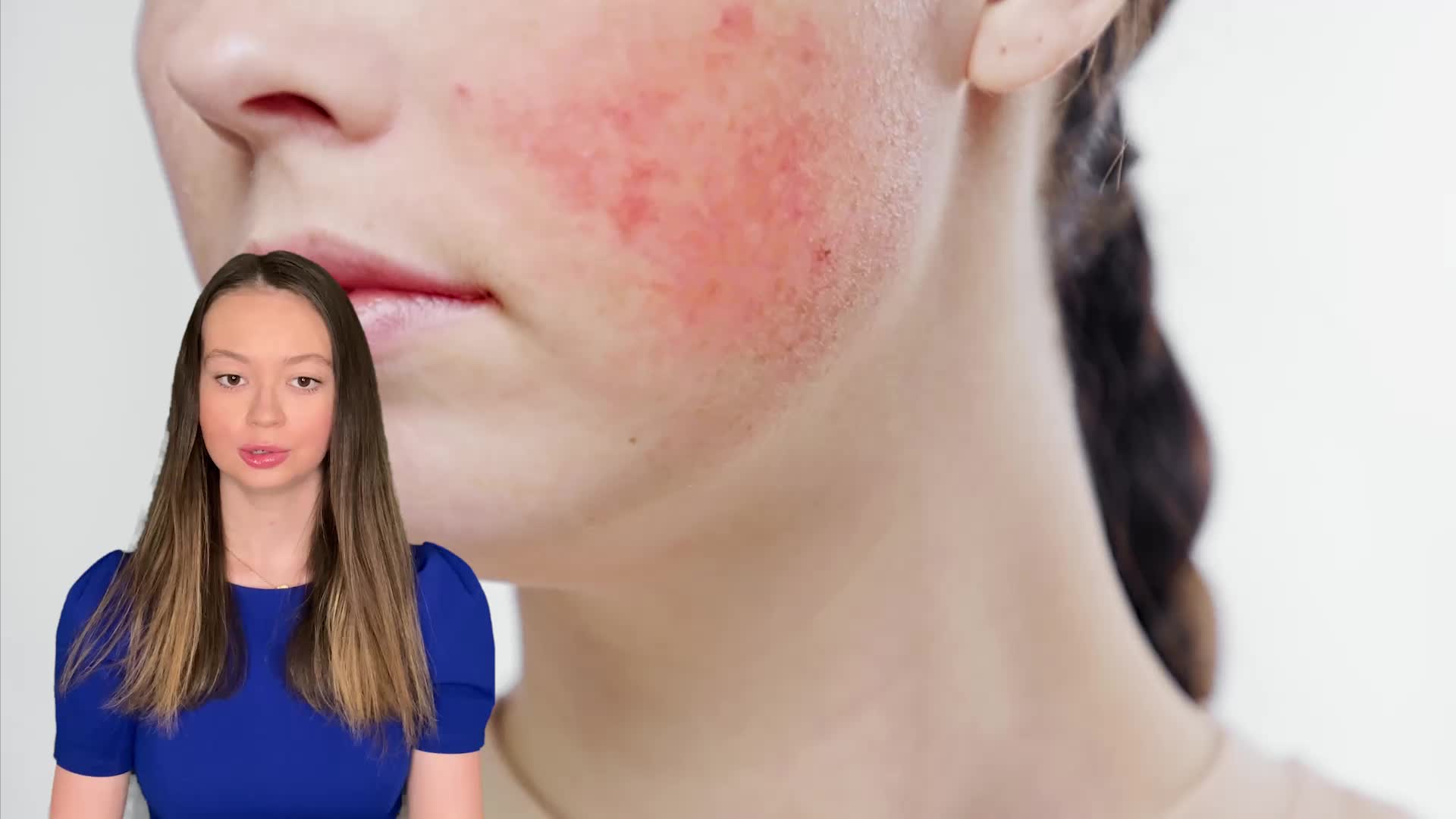 Fight The Flush: Top Tips To Tame Winter Rosacea