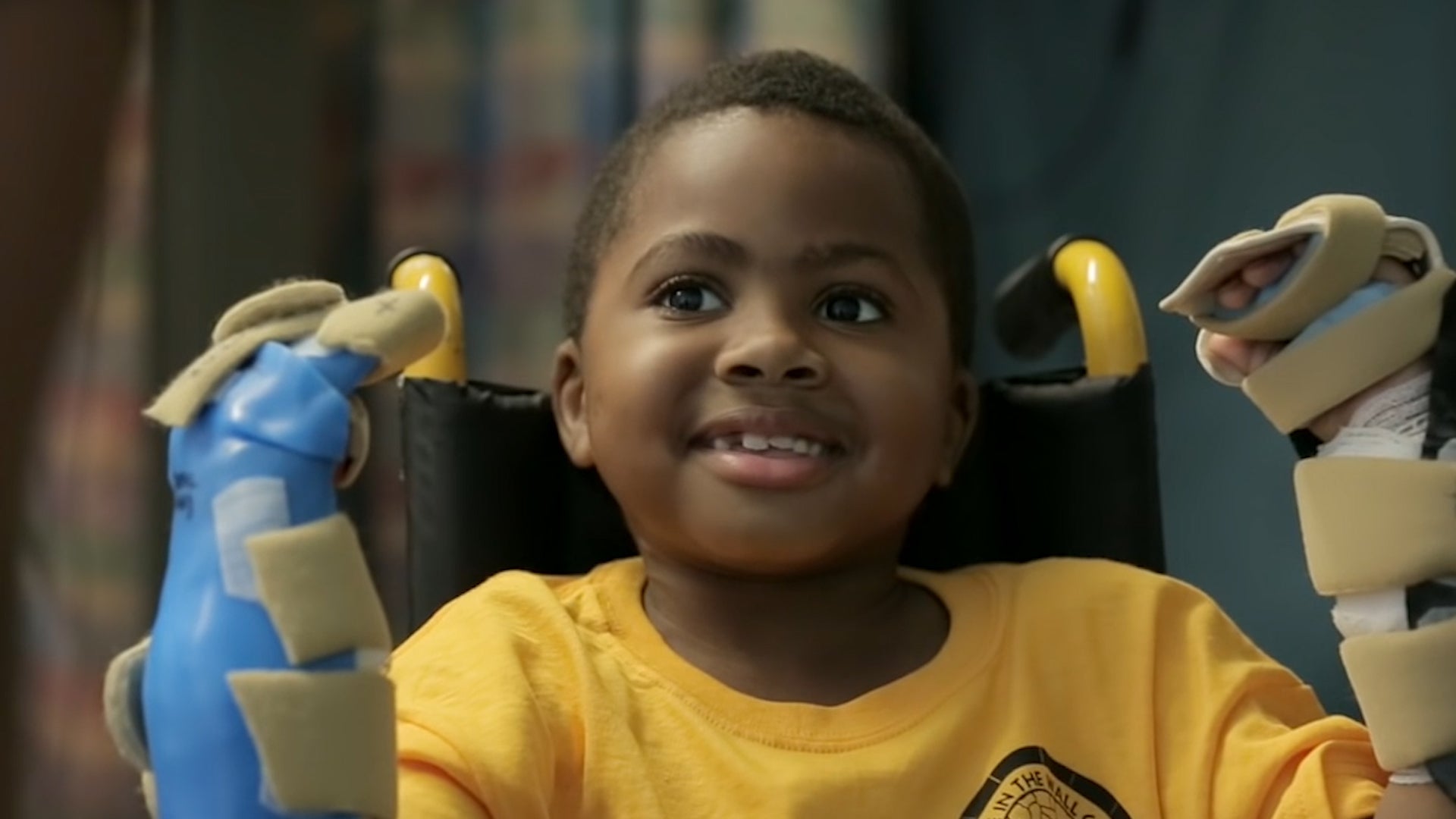First Double Hand Transplant on Child Success