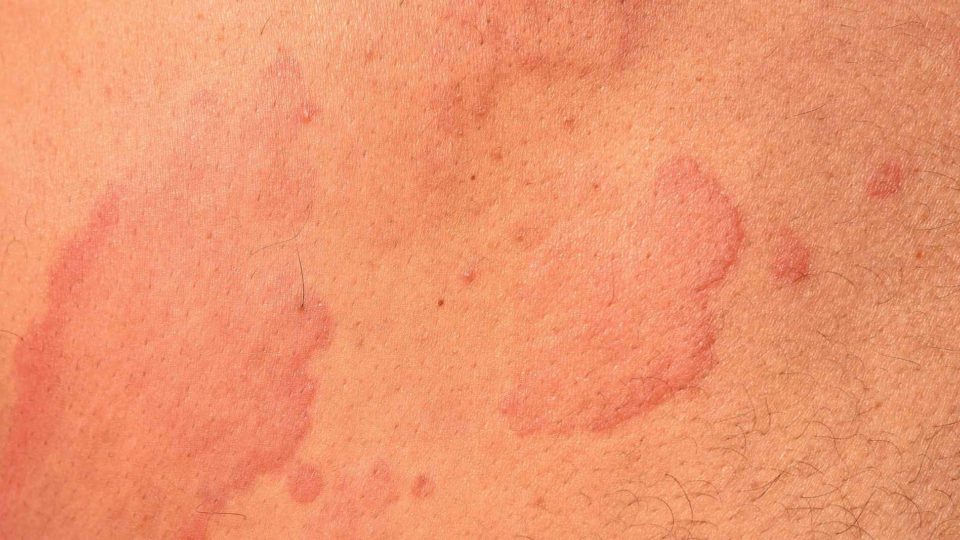 hives