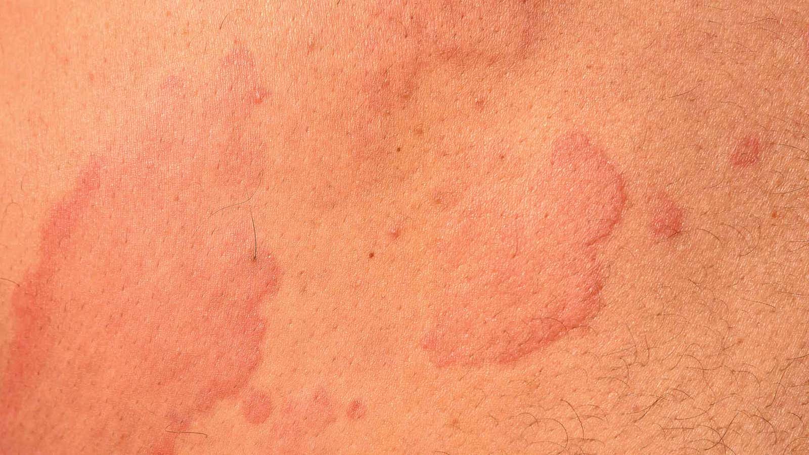 hives