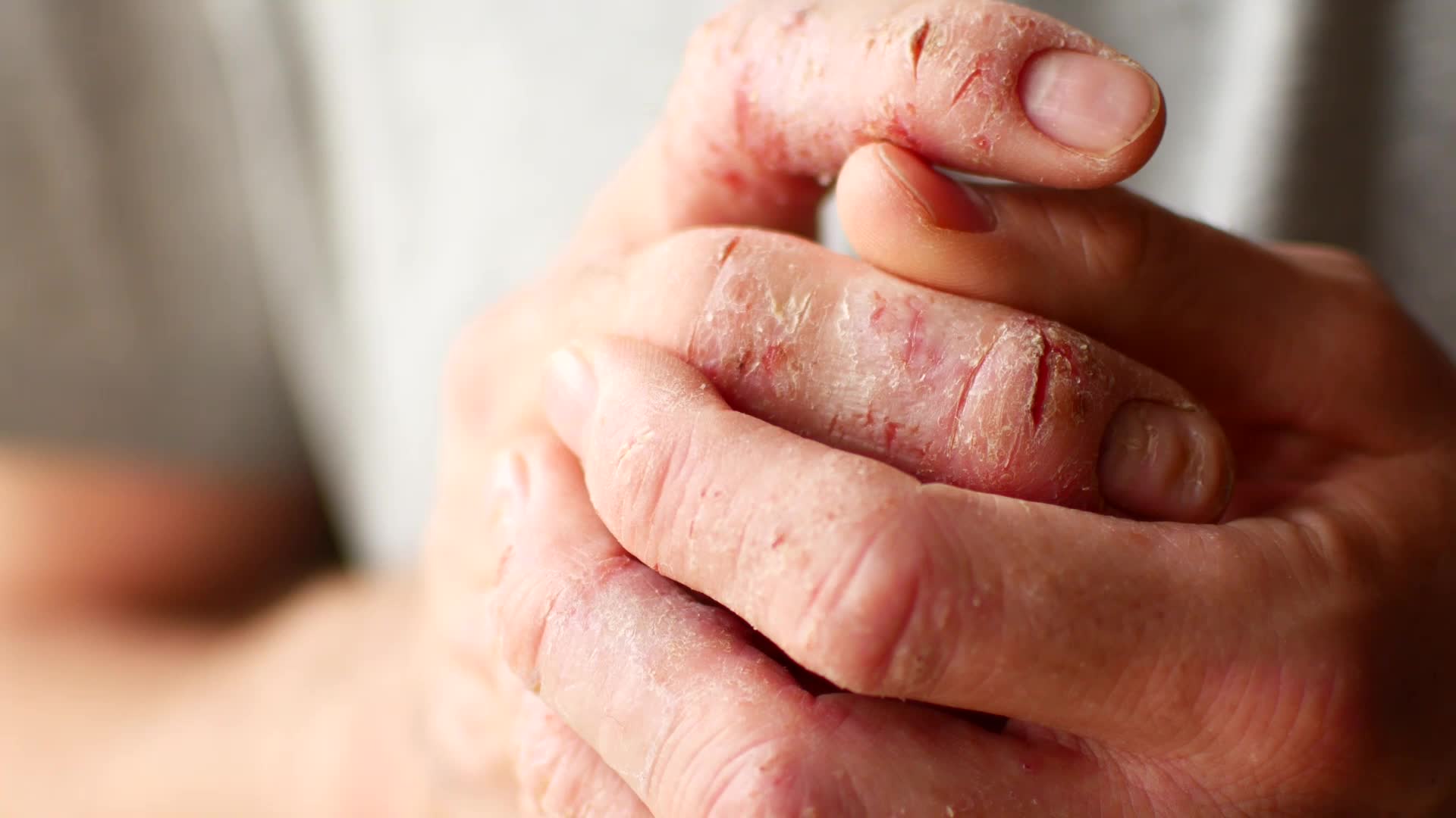 How Chemicals In Your Bed Sheets Can Contribute To Eczema