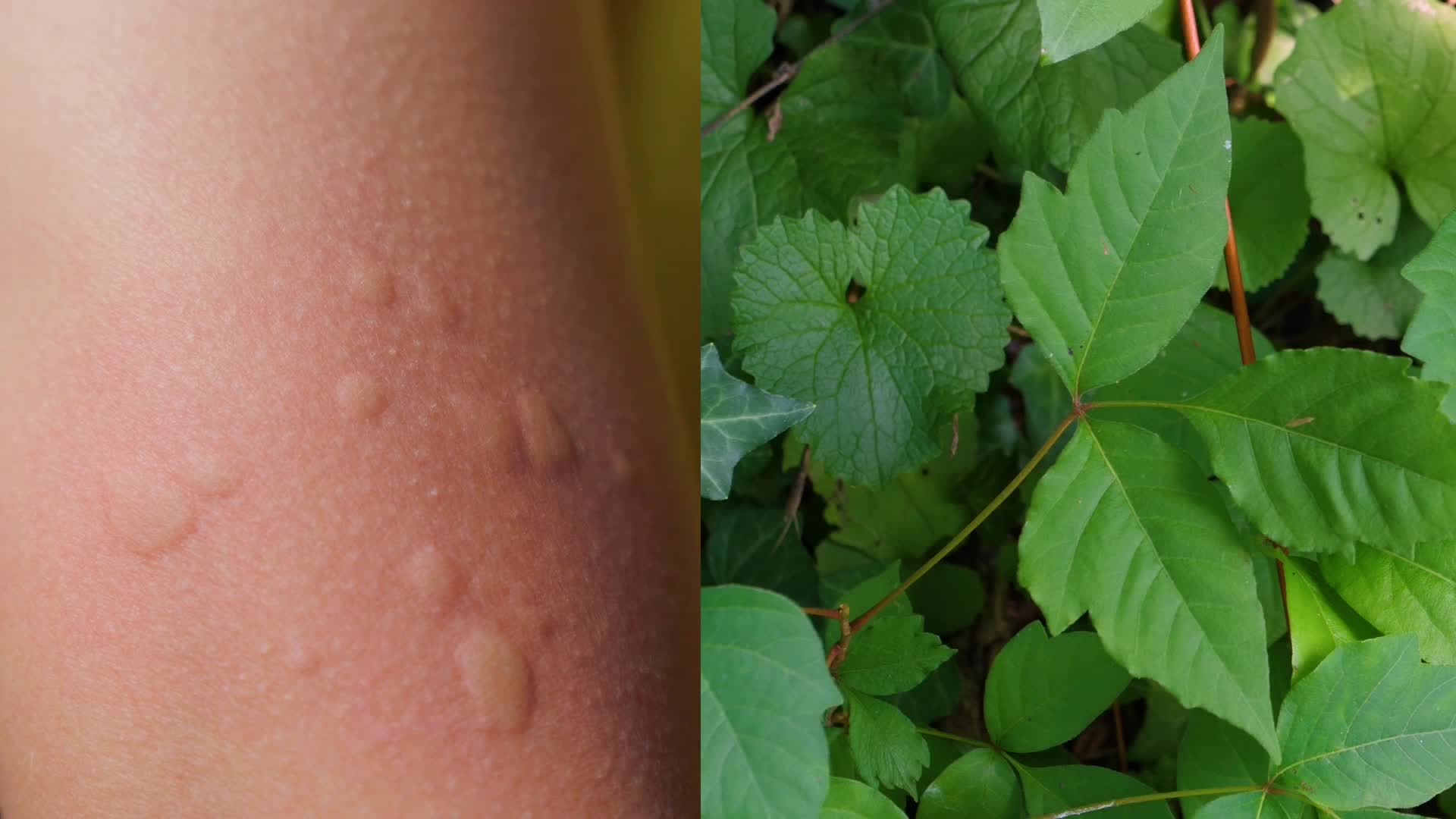 How To Find Soothing Relief From Poison Ivy