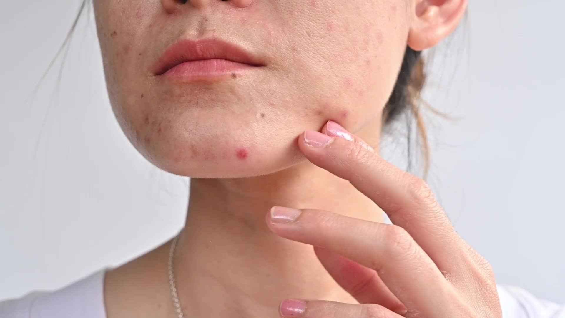How To Prevent Summer Acne Breakouts