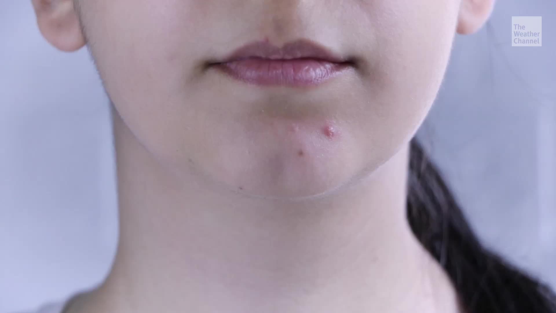 Is It OK To Pop Pimples? 