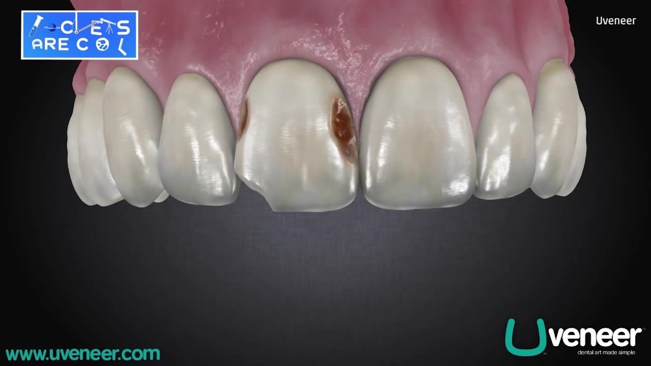 New Veneer Restores Teeth with Ease