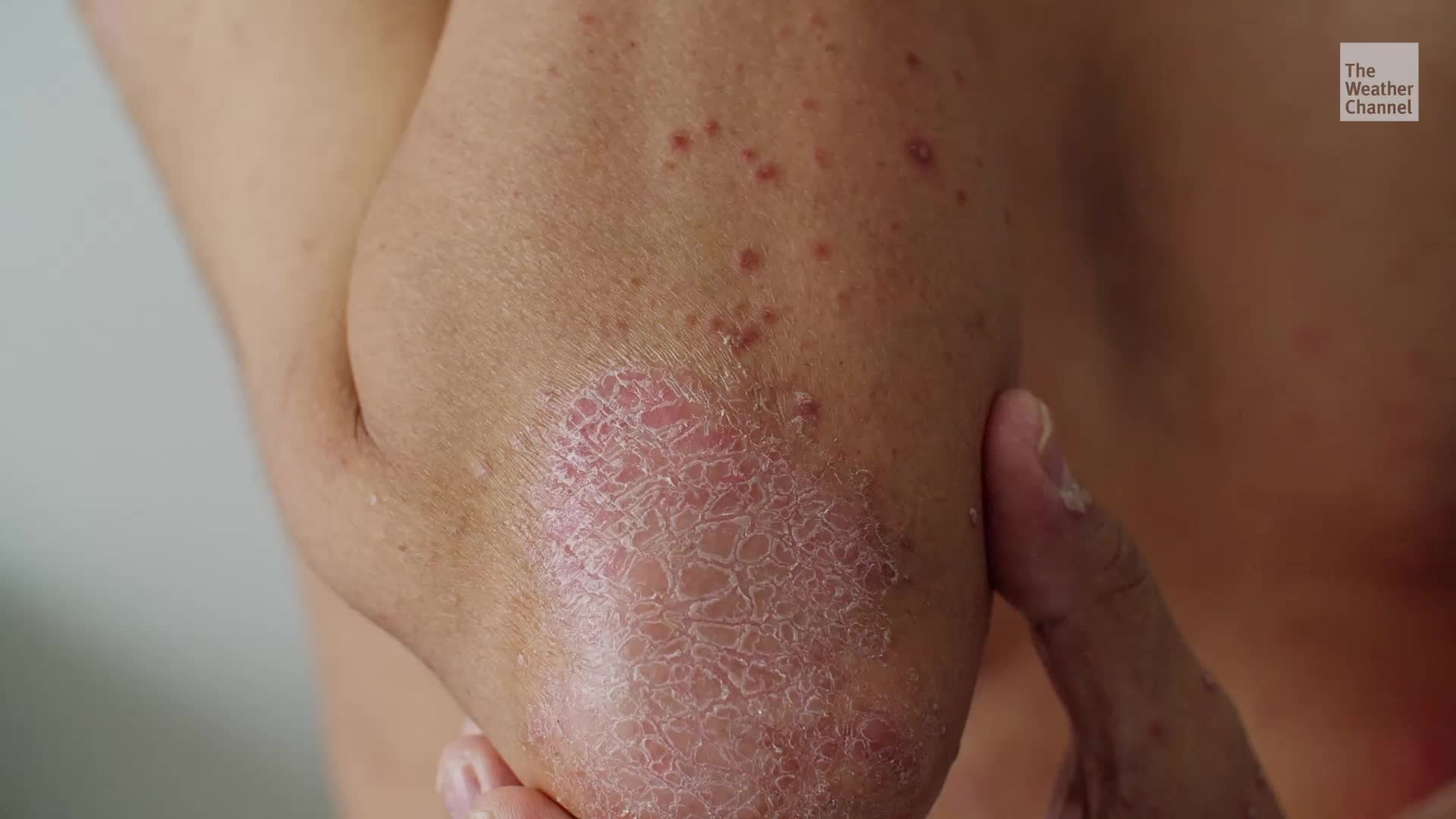 Researchers Think They&rsquo;ve Found The Key To A Psoriasis Cure