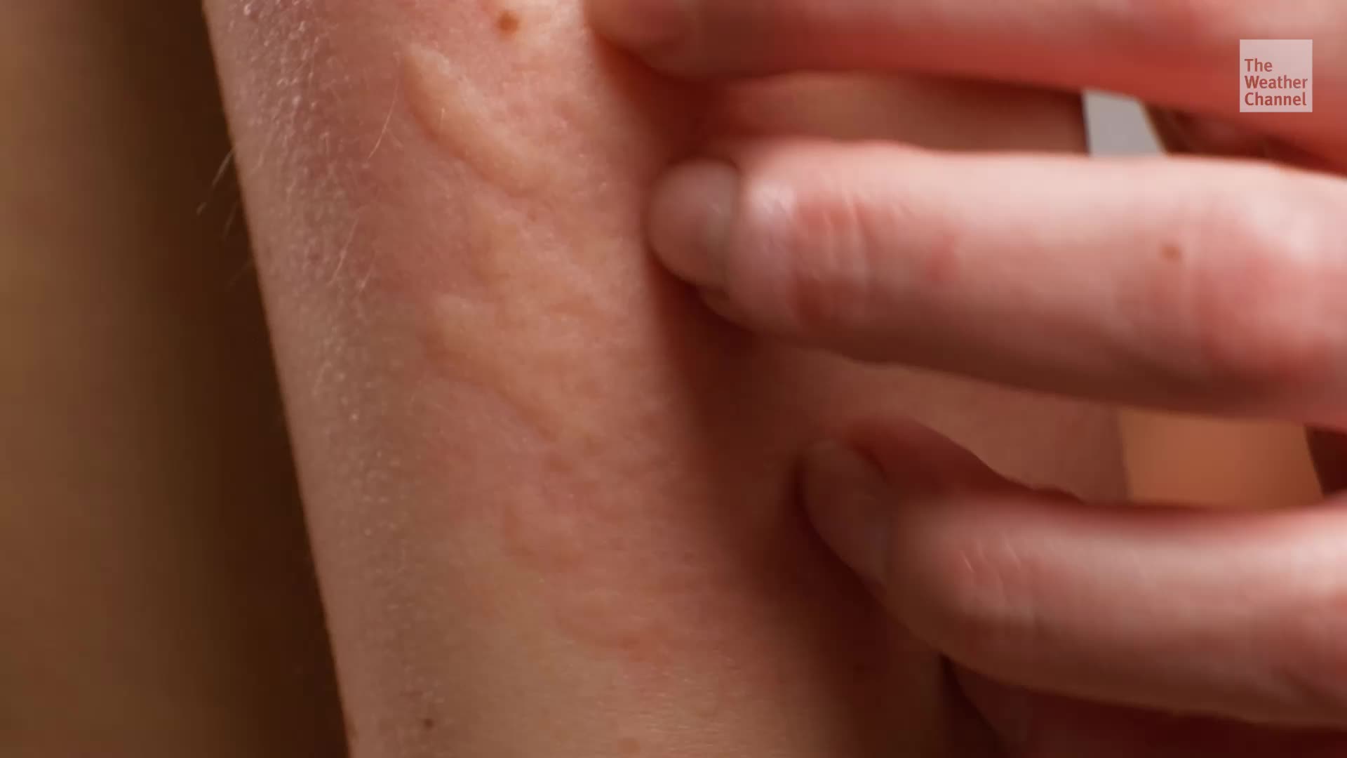 Scabies Surge? What You Should Know