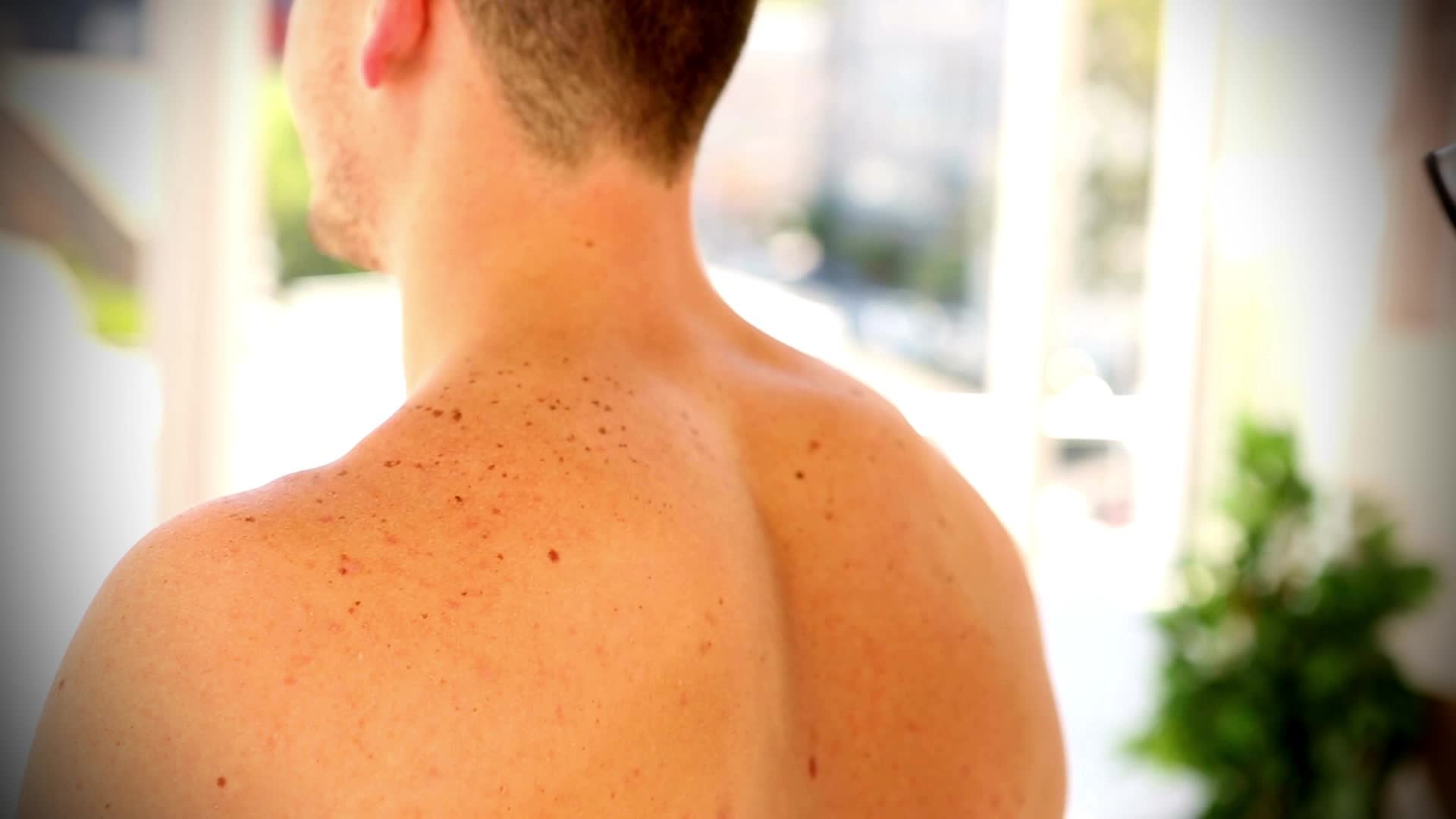 Skin Cancer Impacts 1 In 5. How Often Should You Be Checked?