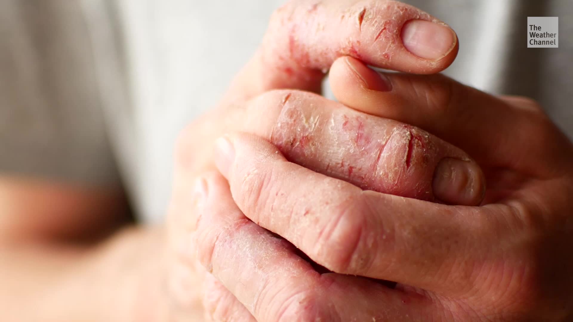 The Best Moisturizers For Acne, Eczema, And Psoriasis