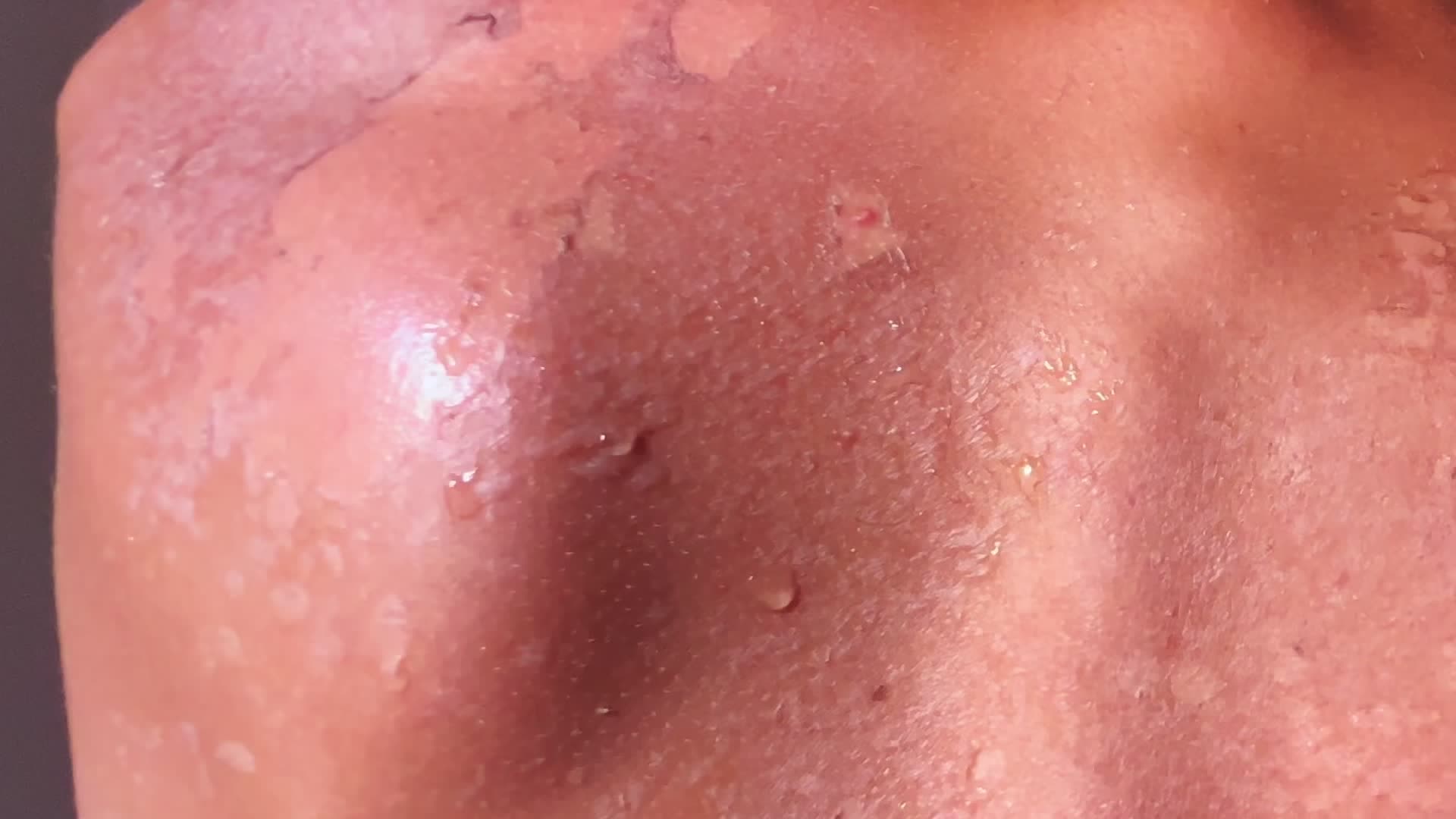 Sunburn? Here are the simplest remedies