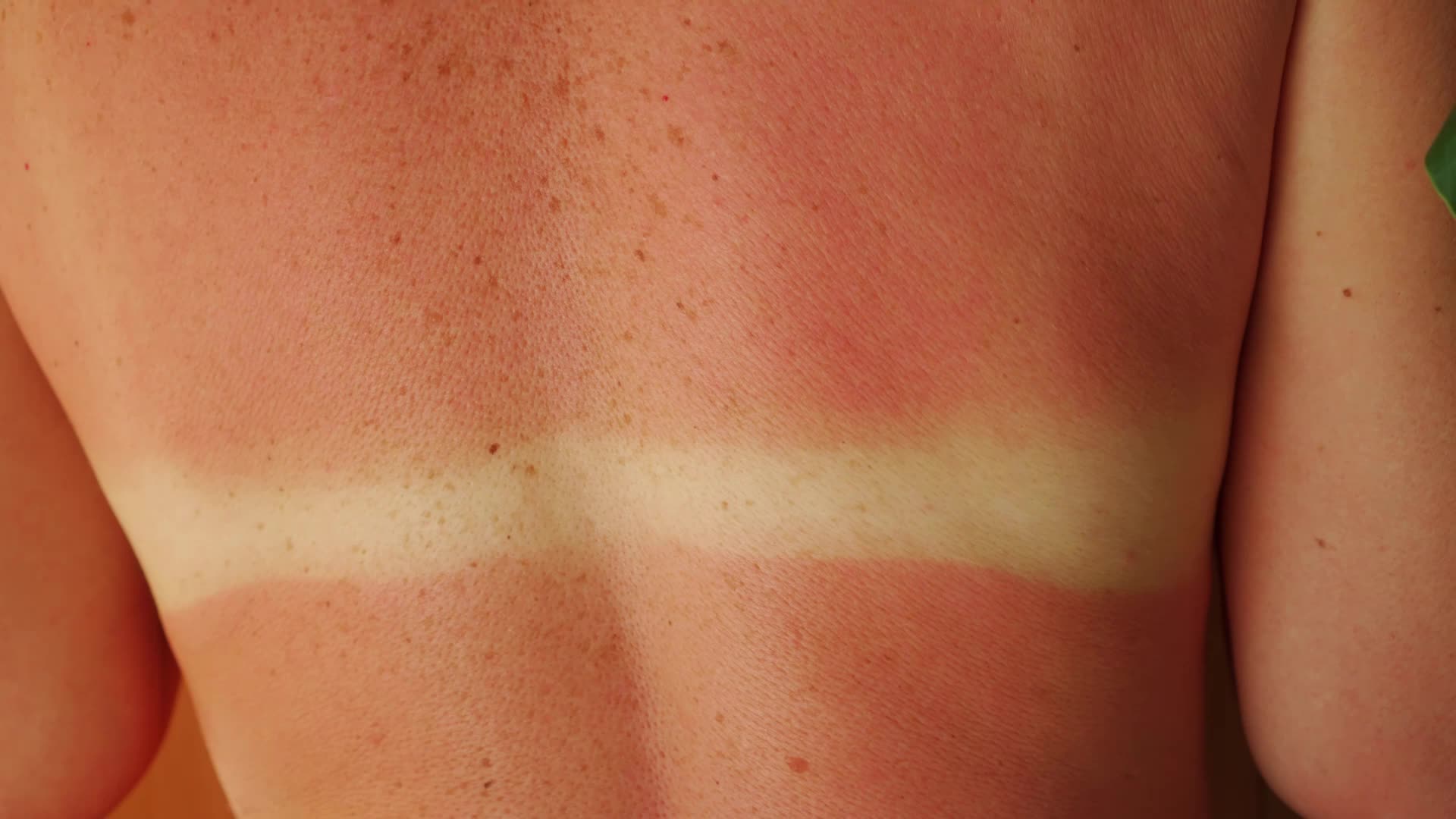What To Do With Peeling, Sunburned Skin